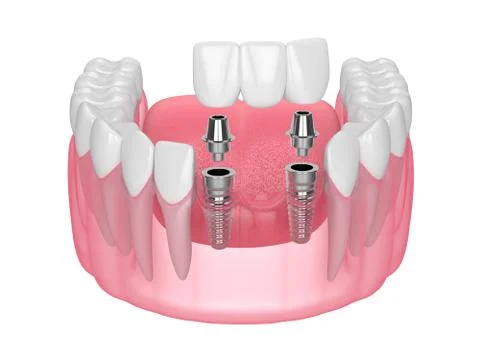 Jaw with implants supporting dental bridge over white Stock Illustration