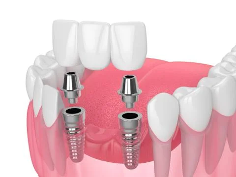 Jaw with implants supporting dental bridge over white Illustrazione stock