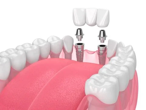 Jaw with implants supporting dental bridge over white Illustrazione stock
