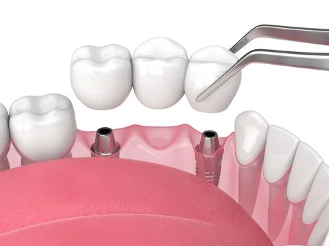 Jaw with implants supporting dental bridge over white Illustrazione stock