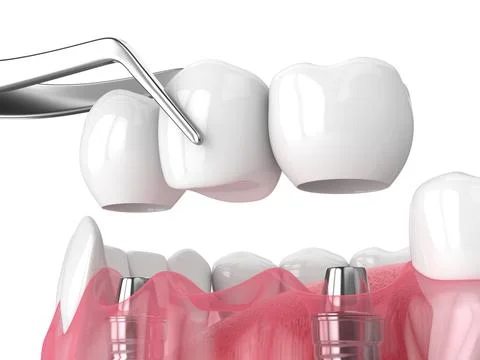 Jaw with implants supporting dental bridge over white Stock Illustration