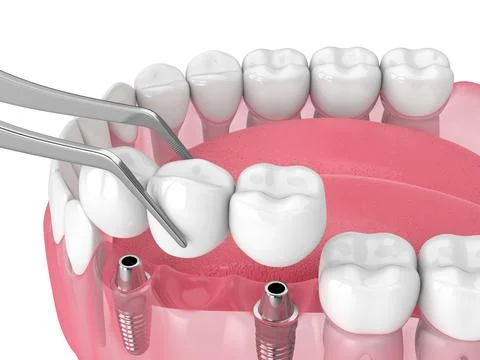 Jaw with implants supporting dental bridge over white Stock Illustration