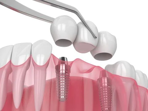 Jaw with implants supporting dental bridge over white Illustrazione stock