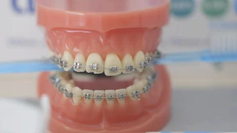 Jaw model with brace on table in clinic Stock Footage 89976479
