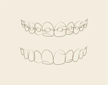 Jaws with and without braces installed beige color Illustrazione stock