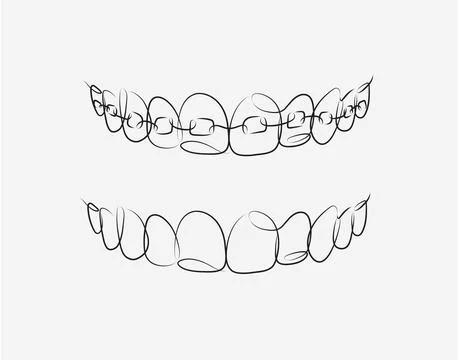 Jaws with and without braces installed white color Illustrazione stock