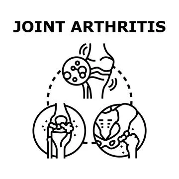 Joint arthritis condition affecting human body anatomy Illustrazione stock