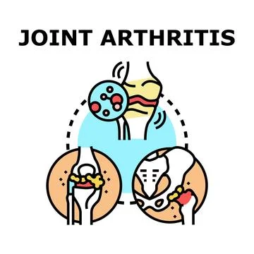 Joint arthritis condition affecting human body anatomy Stock Illustration