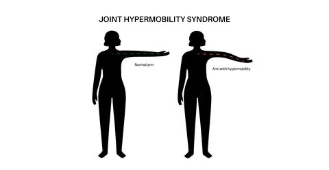 Joint hypermobility poster Stock Illustration