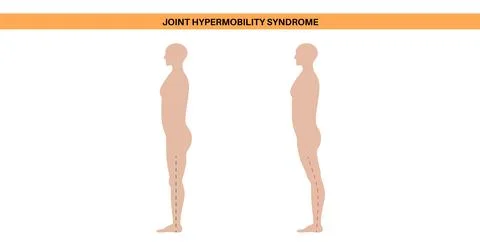 Joint hypermobility poster Stock Illustration
