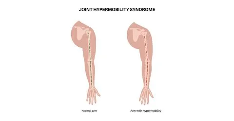 Joint hypermobility poster Illustration