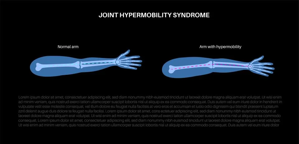 Joint hypermobility poster Illustration