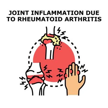 Joint inflammation concept developing rheumatoid arthritis symptoms イラスト素材