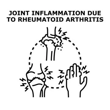 Joint inflammation concept developing rheumatoid arthritis symptoms Stock Illustration