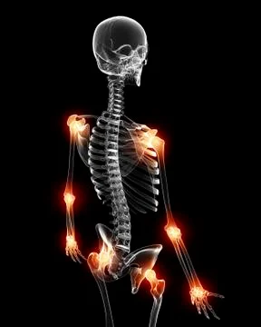 Joint pain, artwork Stock Illustration