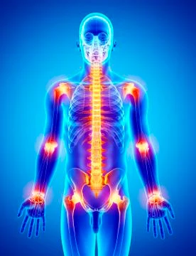 Joint pain, artwork Stock Illustration