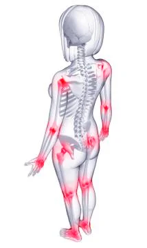 Joint pain, artwork Stock Illustration