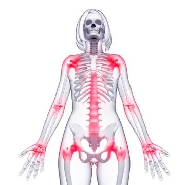 Joint pain, artwork Stock Illustration