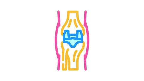 Joint replacement surgery color icon animation Stock Footage 327261737