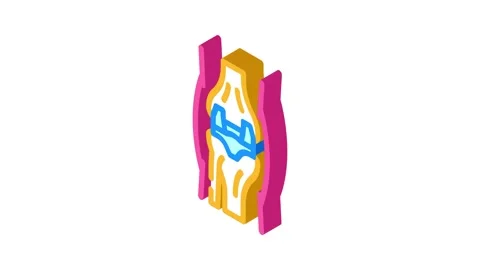 Joint replacement surgery isometric icon animation Stock Footage 327283126
