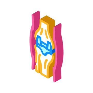 Joint replacement surgery isometric icon vector illustration Stock Illustration