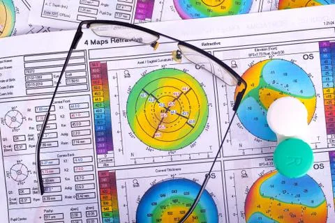 Keratoconus 2-3 stages.. ,corneal topography and vision glasses, peripheral v Stock Photos