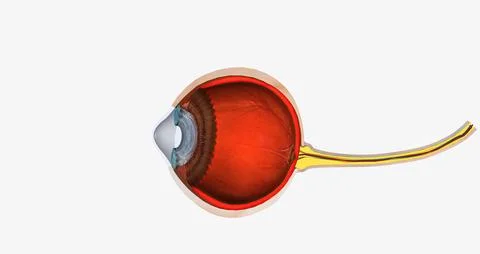 Keratoconus is an eye disease that affects the structure of the cornea. Stock Illustration