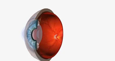 Keratoconus is an eye disease that affects the structure of the cornea. Stock Illustration