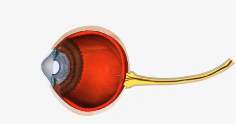 Keratoconus is an eye disease that affects the structure of the cornea. Stock Illustration