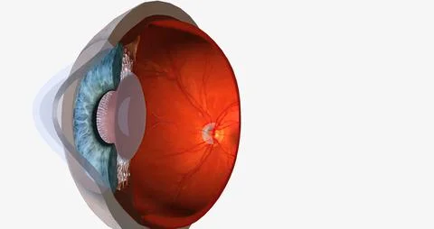 Keratoconus is an eye disease that affects the structure of the cornea. Stock Illustration