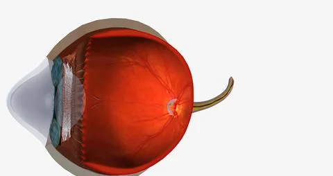 Keratoconus is an eye disease that affects the structure of the cornea. Stock Illustration