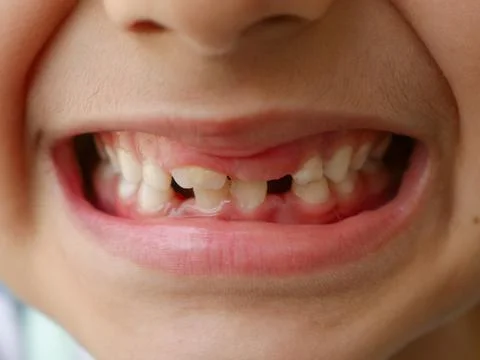 Kid with broken teeth, Gap in teeth Stock Photos