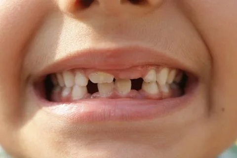 Kid with broken teeth, Gap in teeth Foto stock