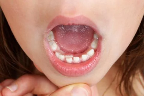 Kid with double row of teeth Stock Photos