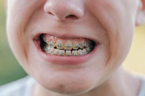 Kid with overbite teeth with fixed metal modern braces construction on teeth Stock Photos