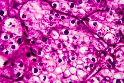Kidney cancer, light micrograph Stock Photos