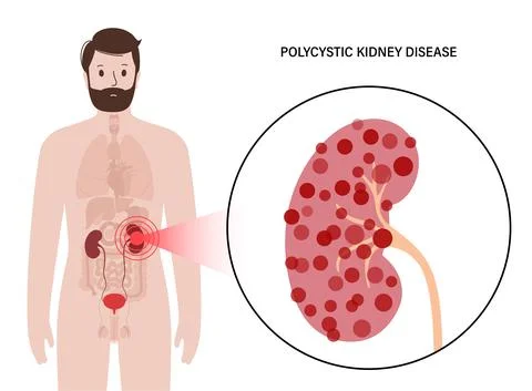 Kidney disease concept Illustrazione stock