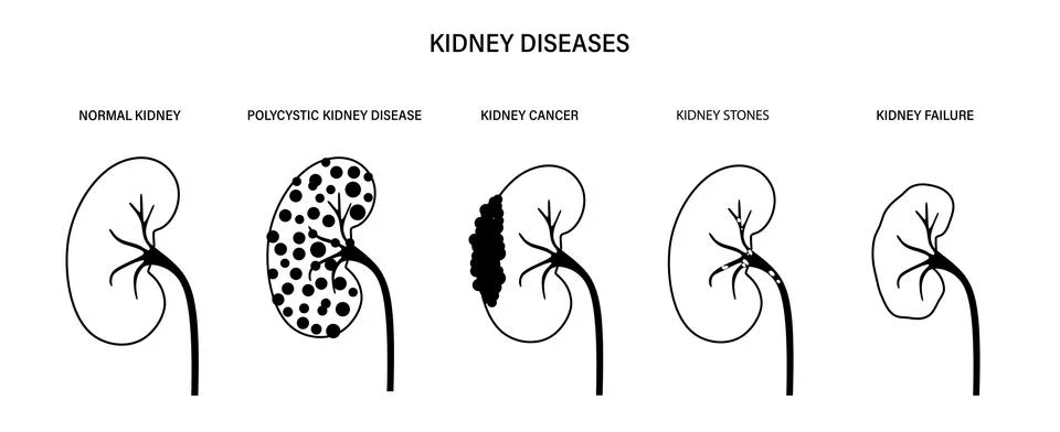 Kidney disease concept Stock Illustration