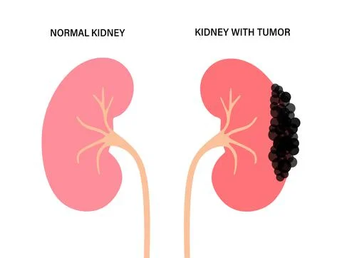 Kidney disease concept Stock Illustration