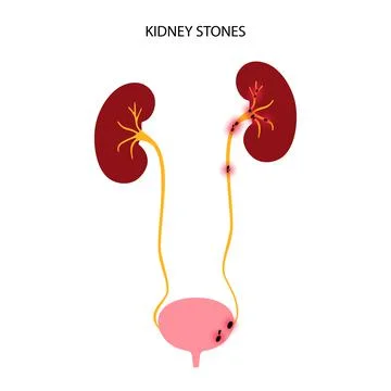 Kidney disease concept Illustrazione stock