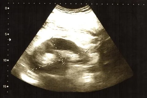 Kidney Stock Illustration