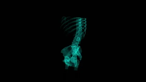 Kidney stone, 3D CT scan Stock Footage 178663739