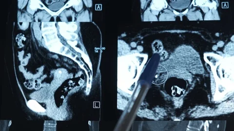 Kidney stone in computed tomography image 動画素材 108144331