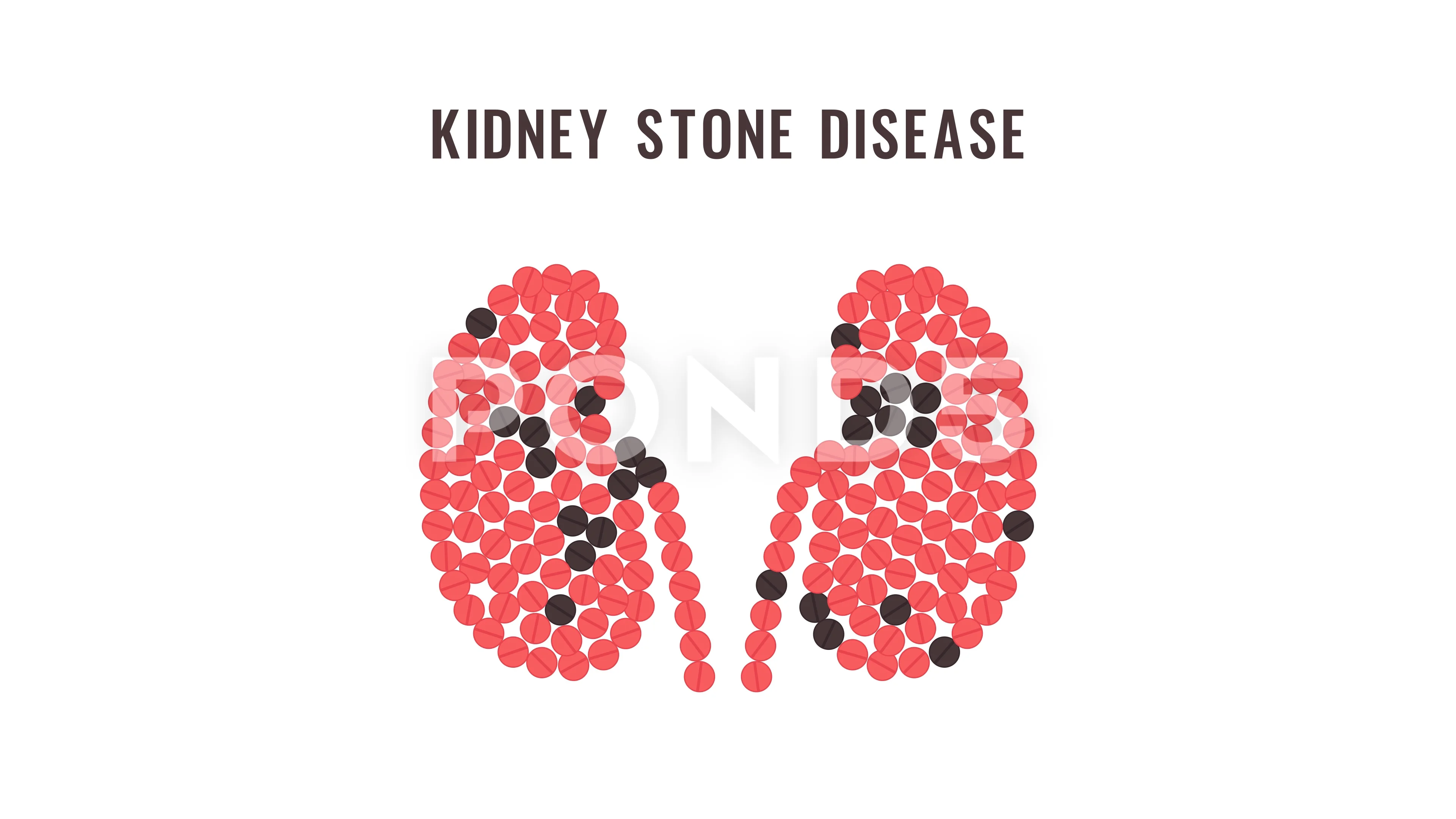 Kidney stone disease pills animation | Stock Video | Pond5