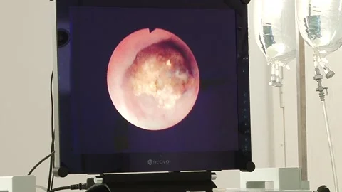 Kidney stone surgery Stock Footage 130793845