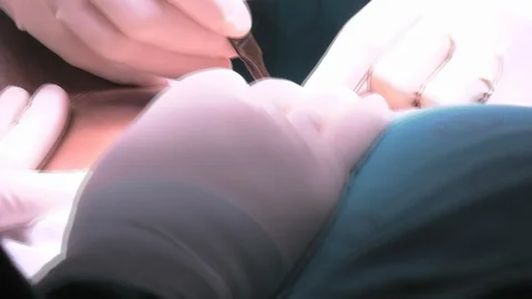 Kidney Surgery Stock Footage 109332213