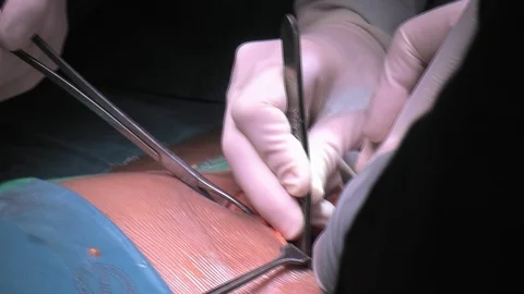 Kidney Surgery Stock Footage 109335741