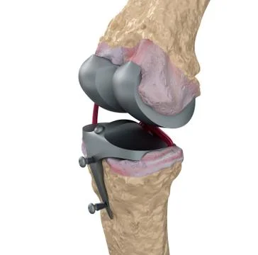 Knee and titanium hinge joint. Isolated on white Illustrazione stock