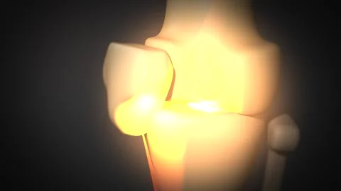 A Knee Animation with Bone on Bone Arthritis Stock Footage 310972332