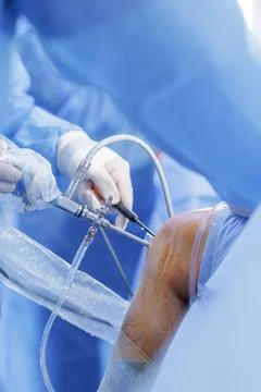 Knee arthroscopy with PCL reconstruction using arthroscope in sterile opera.. Stock Photos